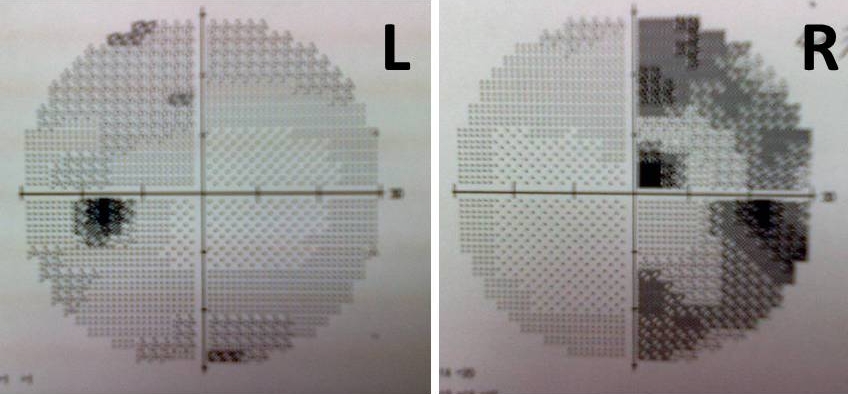Bilateral temporal visual field defect, right > left
